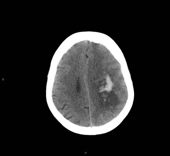 File:Basal ganglia hemorrhage (Radiopaedia 58759-65981 Axial non-contrast 17).jpg