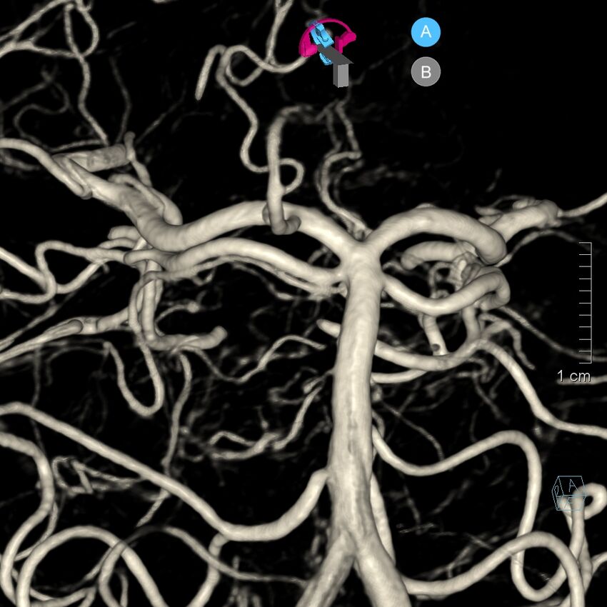 Basilar artery perforator aneurysm (Radiopaedia 82455-97734 3D view left VA 119).jpg
