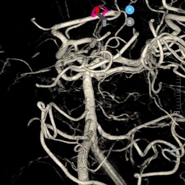 File:Basilar artery perforator aneurysm (Radiopaedia 82455-97734 3D view left VA 5).jpg
