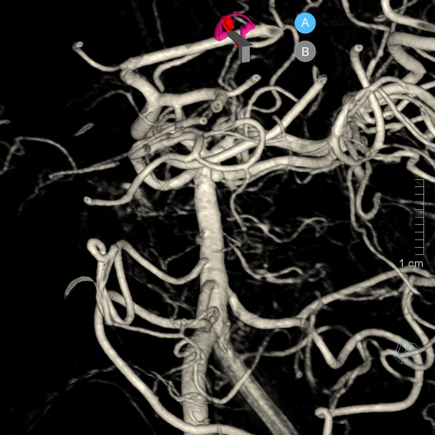 Basilar artery perforator aneurysm (Radiopaedia 82455-97734 3D view left VA 5).jpg