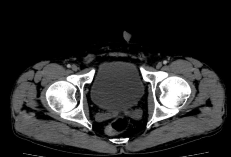 File:Behçet's disease- abdominal vasculitis (Radiopaedia 55955-62570 A 88).jpg