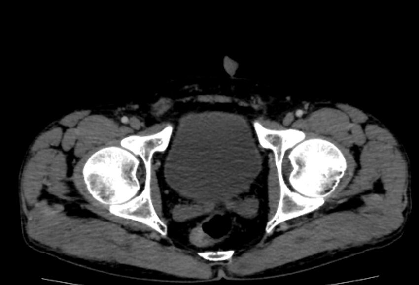 Behçet's disease- abdominal vasculitis (Radiopaedia 55955-62570 A 88).jpg