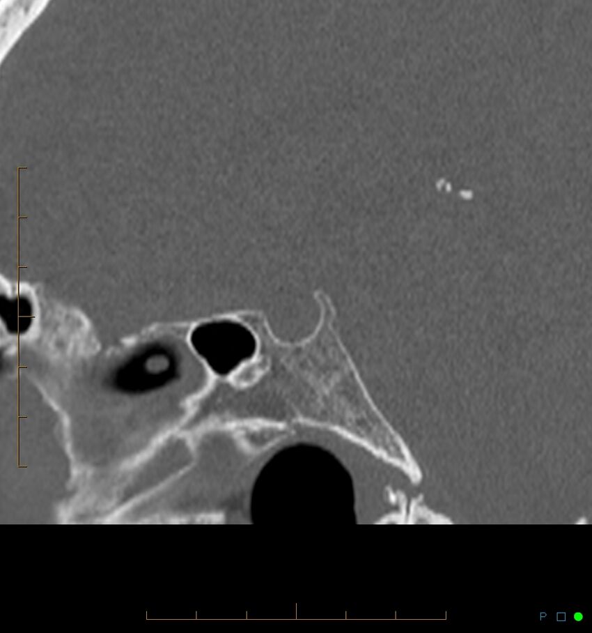 Benign notochordal cell tumor (probable) (Radiopaedia 65475-74546 Sagittal bone window 24).jpg