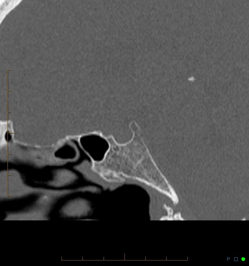 Benign notochordal cell tumor (probable) (Radiopaedia 65475-74546 Sagittal bone window 27).jpg
