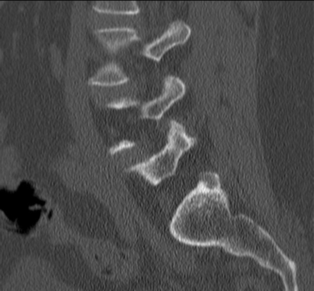 File:Bertolotti syndrome (Radiopaedia 24864-25128 Sagittal bone window 18).jpg