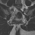 Bicornuate uterus (Radiopaedia 24677-24949 Coronal T2 17).jpg