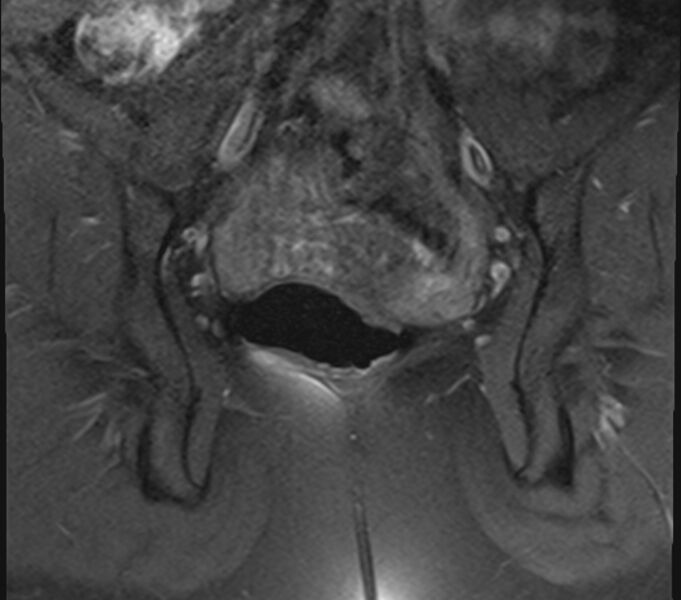 File:Bicornuate uterus (Radiopaedia 71214-81511 Coronal T1 fat sat 13).jpg
