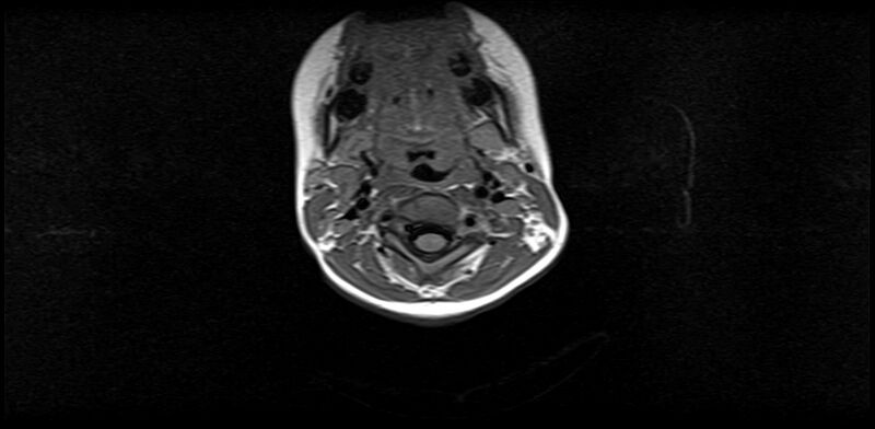 File:Bilateral Sprengel deformity with Klippel-Feil syndrome (Radiopaedia 66395-75650 Axial T1 9).jpg