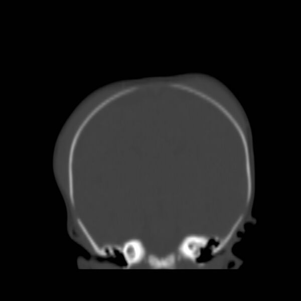 File:Bilateral cephalohematomas and subdural hematomas (Radiopaedia 26778-26929 Coronal bone window 13).jpg