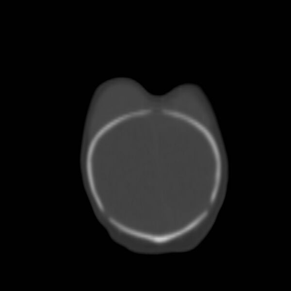 File:Bilateral cephalohematomas and subdural hematomas (Radiopaedia 26778-26929 Coronal bone window 33).jpg