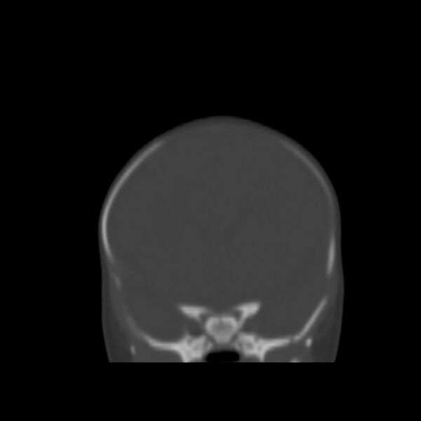 File:Bilateral cephalohematomas and subdural hematomas (Radiopaedia 26778-26929 Coronal bone window 5).jpg