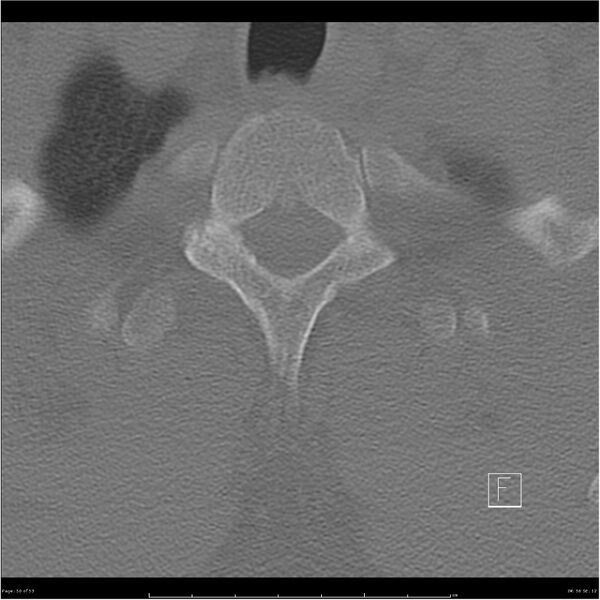 File:Bilateral cervical ribs (Radiopaedia 25868-26017 Axial bone window 50).jpg