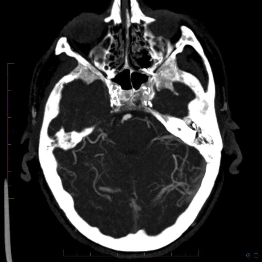 Bilateral chronic common carotid occlusion (Radiopaedia 50849-56362 D 21).jpg