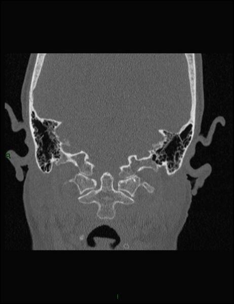 File:Bilateral frontal mucoceles (Radiopaedia 82352-96454 Coronal 339).jpg