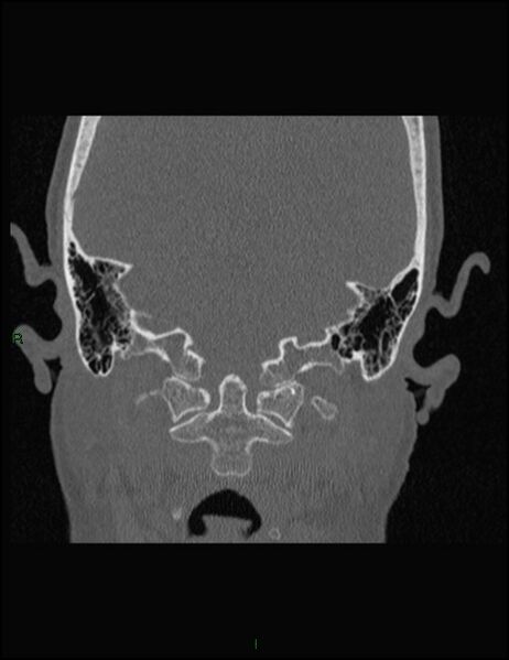 File:Bilateral frontal mucoceles (Radiopaedia 82352-96454 Coronal 340).jpg
