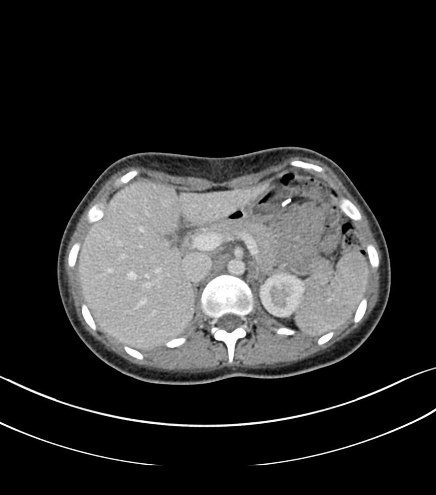 Bilateral kidney malrotation (Radiopaedia 72227-82749 A 5).jpg