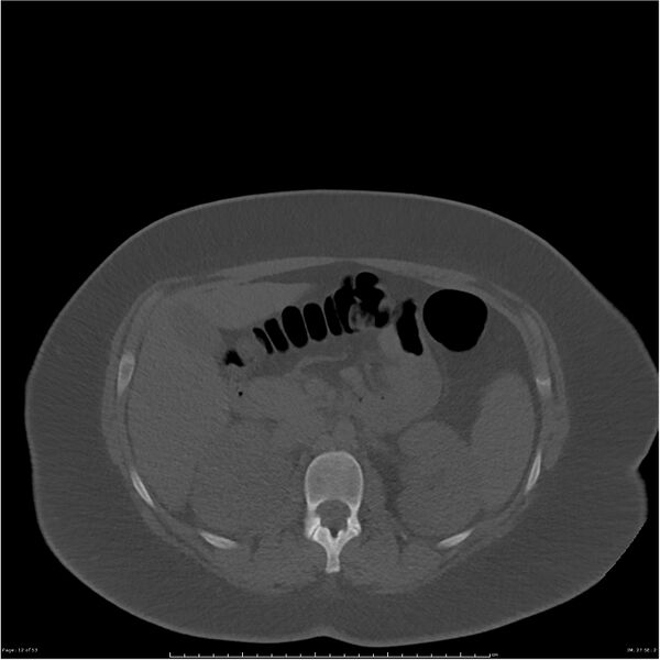 File:Bilateral lumbar ribs (Radiopaedia 25862-26010 bone window 12).jpg