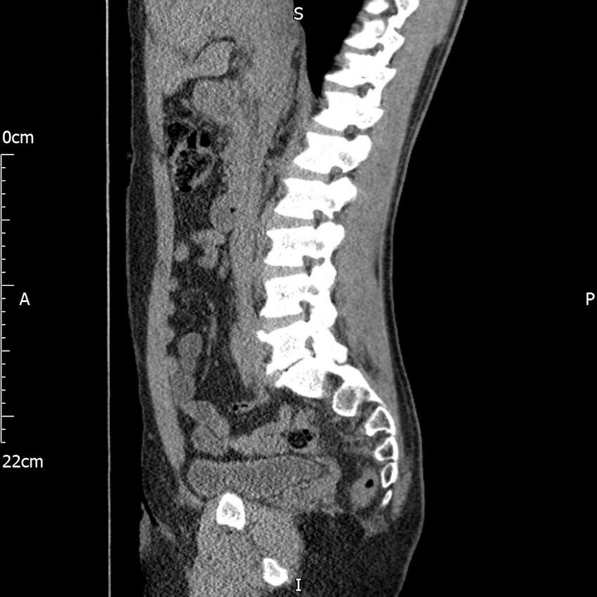 Bilateral medullary nephrocalcinosis with ureteric calculi (Radiopaedia 71269-81569 C 68).jpg
