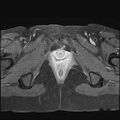 Bilateral ovarian endometriomas (Radiopaedia 87085-103347 Axial T1 C+ fat sat 21).jpg