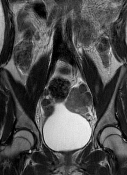 File:Bilateral ovarian fibrothecomas - adolescent (Radiopaedia 86604-102707 Coronal T2 16).jpg