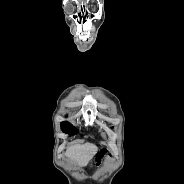 File:Bilateral parotid gland lymphoma (Radiopaedia 21038-20969 B 2).jpg