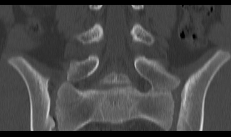 File:Bilateral pars defect (Radiopaedia 26691-26846 Coronal bone window 25).jpg