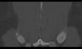 Bilateral pars defect (Radiopaedia 26691-26846 Coronal bone window 44).jpg