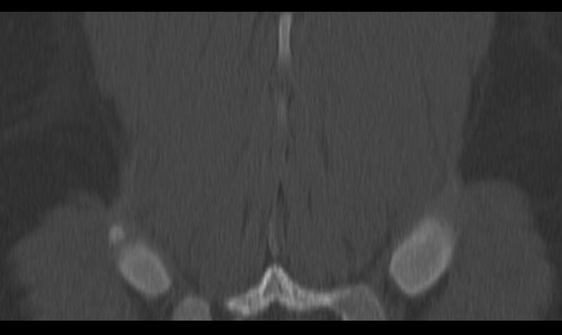 File:Bilateral pars defect (Radiopaedia 26691-26846 Coronal bone window 44).jpg