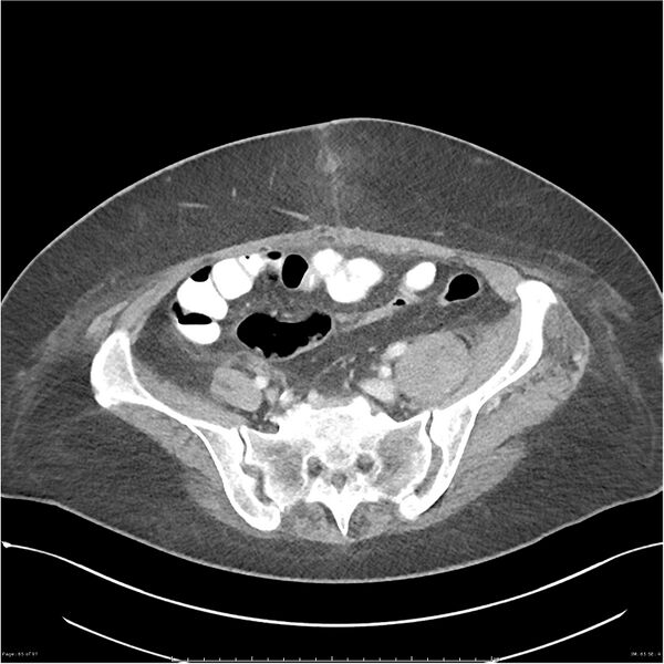 File:Bilateral psoas hematomas (Radiopaedia 24057-24279 A 65).jpg