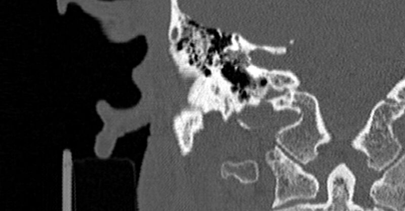 File:Bilateral temporal bone fractures (Radiopaedia 29482-29970 Coronal non-contrast 114).jpg