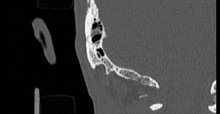 Bilateral temporal bone fractures (Radiopaedia 29482-29970 Coronal non-contrast 178).jpg