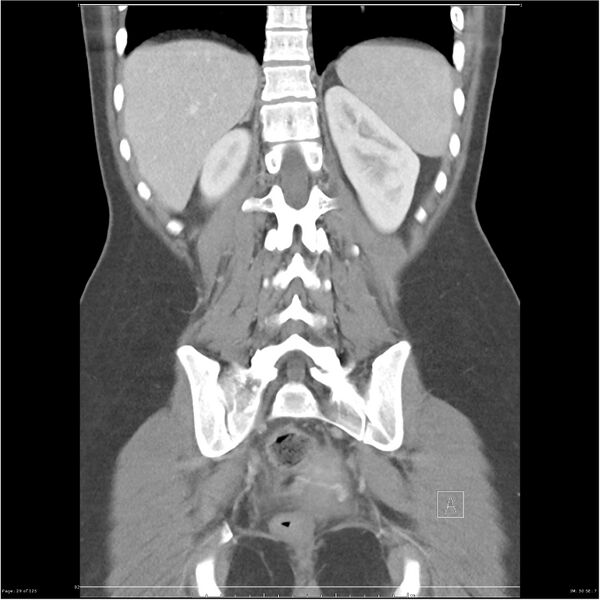 File:Bilateral ureteritis and cystitis (Radiopaedia 25340-25594 B 29).jpg