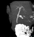 Bile leak from accessory duct(s) of Luschka post cholecystectomy (Radiopaedia 40736-43389 D 20).jpg