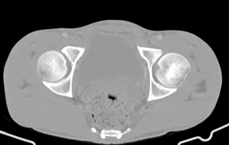 File:Blunt injury to the small bowel (Radiopaedia 74953-85987 Axial Wide 91).jpg