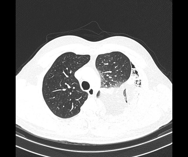 File:Bochdalek hernia - adult presentation (Radiopaedia 74897-85925 Axial lung window 12).jpg