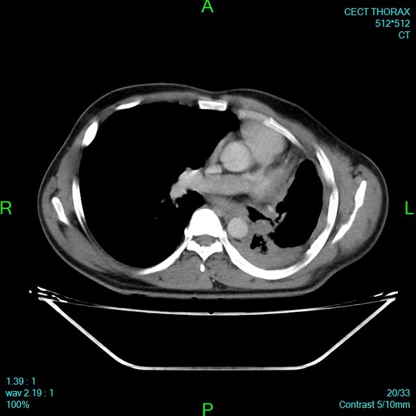 File:Bone metastases from lung carcinoma (Radiopaedia 54703-60937 Axial C+ delayed 20).jpg