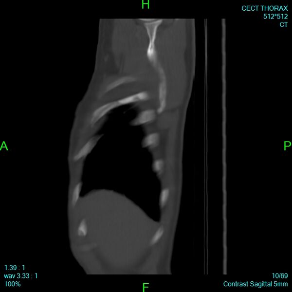 File:Bone metastases from lung carcinoma (Radiopaedia 54703-60937 Sagittal bone window 10).jpg