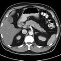 Bosniak cyst - type IV (Radiopaedia 23525-23627 renal cortical phase 9).jpg