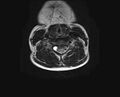 Brachial plexus birth palsy (Radiopaedia 68118-77604 Axial T2 11).jpg