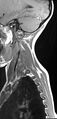 Brachial plexus birth palsy (Radiopaedia 68118-77604 Sagittal T1 1).jpg
