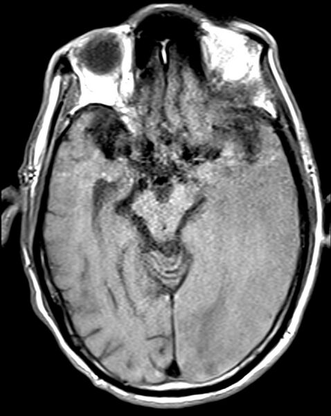 File:Brain abscess with dual rim sign (Radiopaedia 87566-103938 Axial T1 9).jpg
