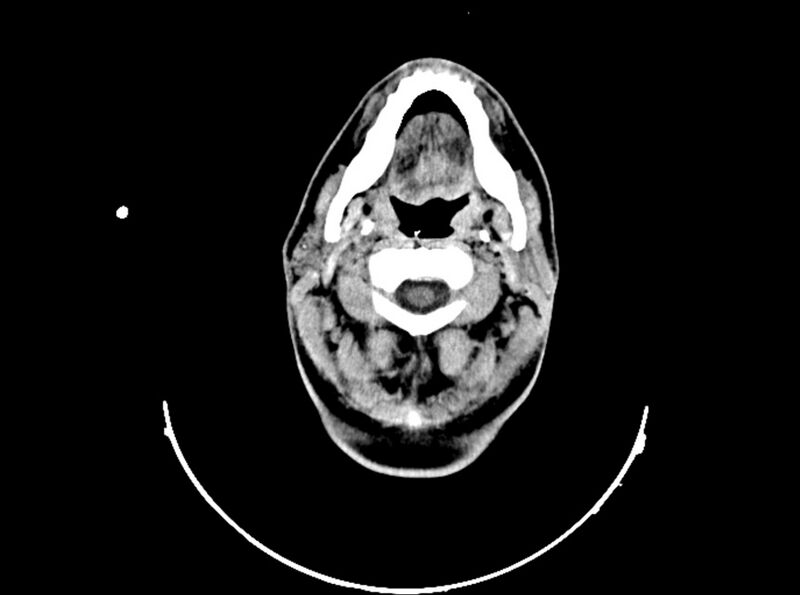 File:Brain injury by firearm projectile (Radiopaedia 82068-96088 A 47).jpg