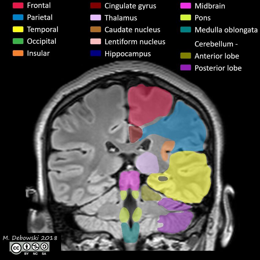 Brain lobes - annotated MRI (Radiopaedia 61691-69700 Coronal 44).JPG