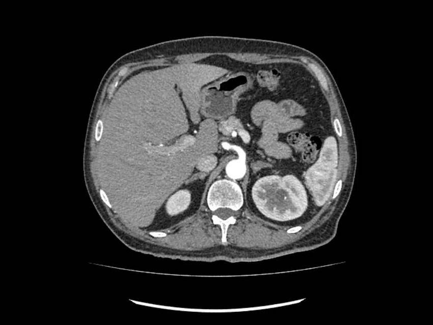 Brain metastases from renal cell carcinoma (Radiopaedia 42222-45328 A 31).jpg