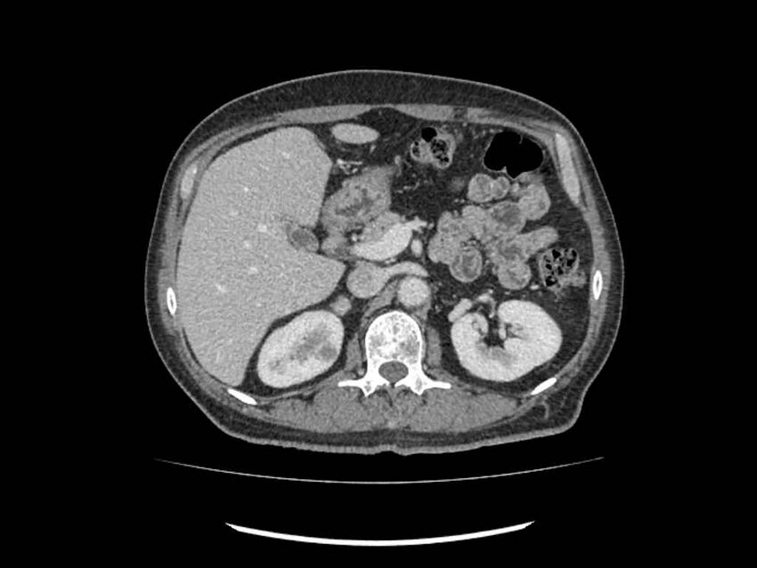 Brain metastases from renal cell carcinoma (Radiopaedia 42222-45328 B 60).jpg