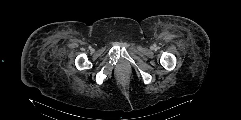 File:Breast cancer pelvic bony metastases (Radiopaedia 84470-99824 Axial bone window 74).jpg