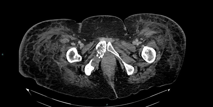 Breast cancer pelvic bony metastases (Radiopaedia 84470-99824 Axial bone window 74).jpg