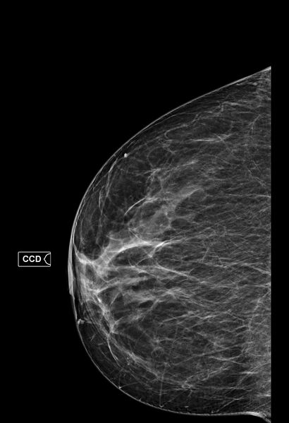File:Breast fibroadenoma (Radiopaedia 82986-97340 CC 1).jpg