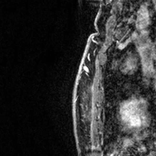 File:Breast implants - MRI (Radiopaedia 26864-27035 Sagittal T2 79).jpg