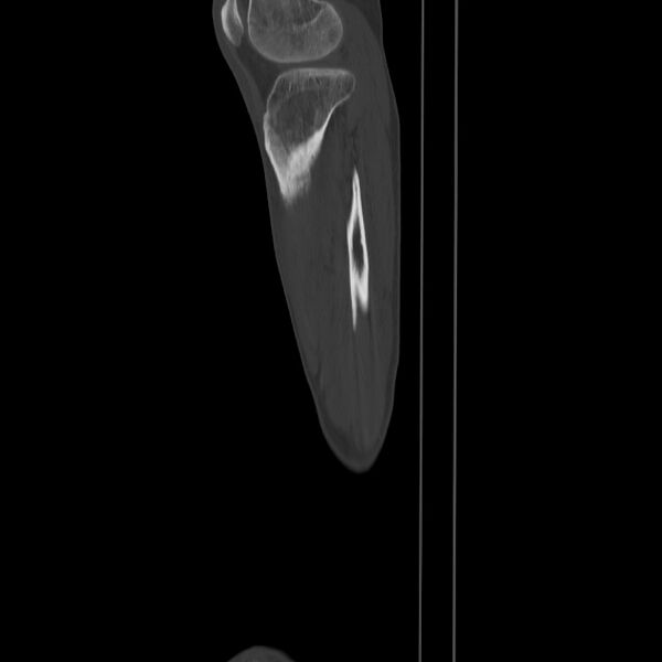 File:Brodie abscess - tibia (Radiopaedia 66028-75204 Sagittal bone window 65).jpg
